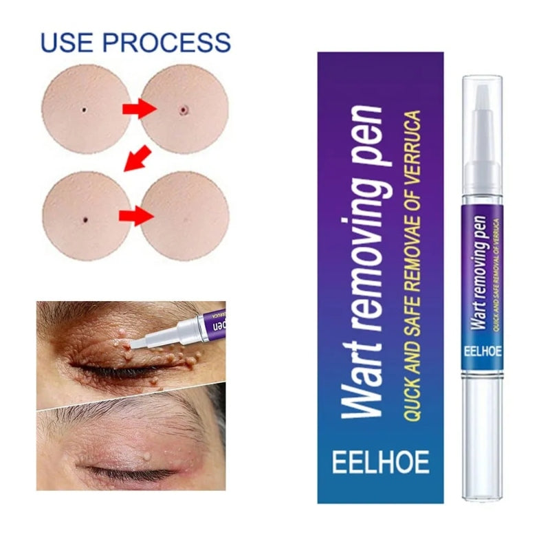 Warts Liquid Pen Woman Skin moles Remove Black Dots