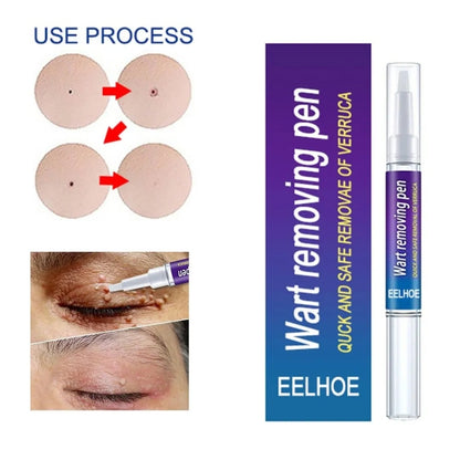 Warts Liquid Pen Woman Skin moles Remove Black Dots