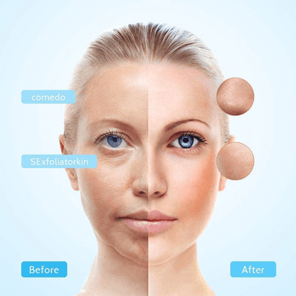 Electric suction blackhead remover pore cleanser