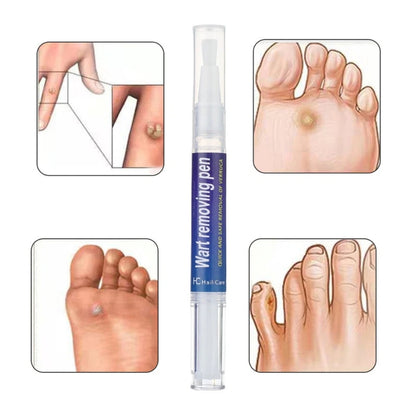 Warts Liquid Pen Woman Skin moles Remove Black Dots